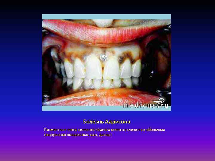 Болезнь Аддисона Пигментные пятна синевато чёрного цвета на слизистых оболочках (внутренняя поверхность щек, десны)