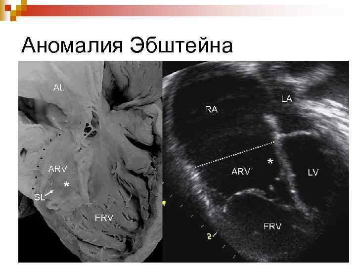 Аномалия Эбштейна 