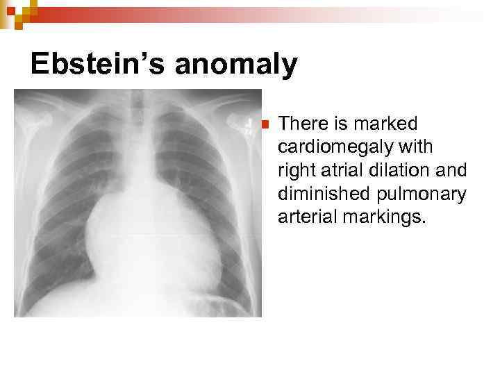 Ebstein’s anomaly n There is marked cardiomegaly with right atrial dilation and diminished pulmonary