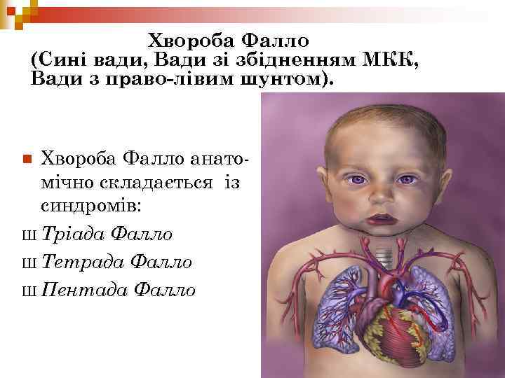 Хвороба Фалло (Сині вади, Вади зі збідненням МКК, Вади з право-лівим шунтом). Хвороба Фалло