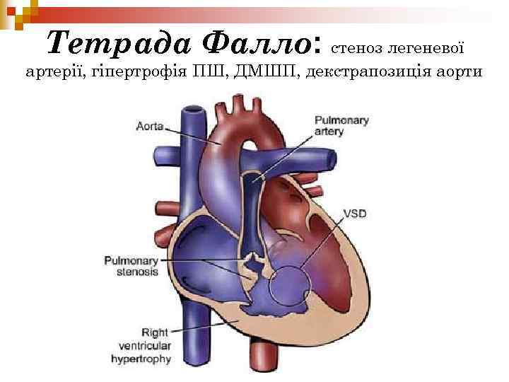 Тетрада Фалло: стеноз легеневої артерії, гіпертрофія ПШ, ДМШП, декстрапозиція аорти 