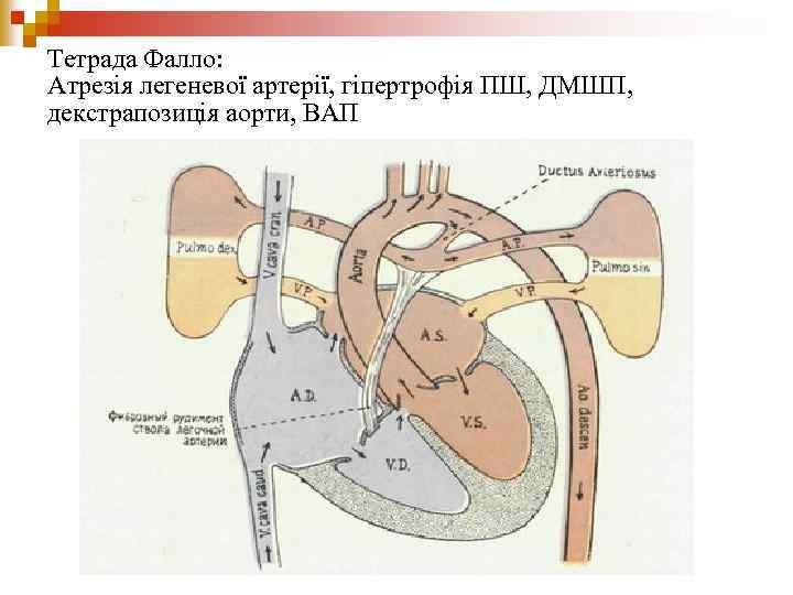 Тетрада Фалло: Атрезія легеневої артерії, гіпертрофія ПШ, ДМШП, декстрапозиція аорти, ВАП 