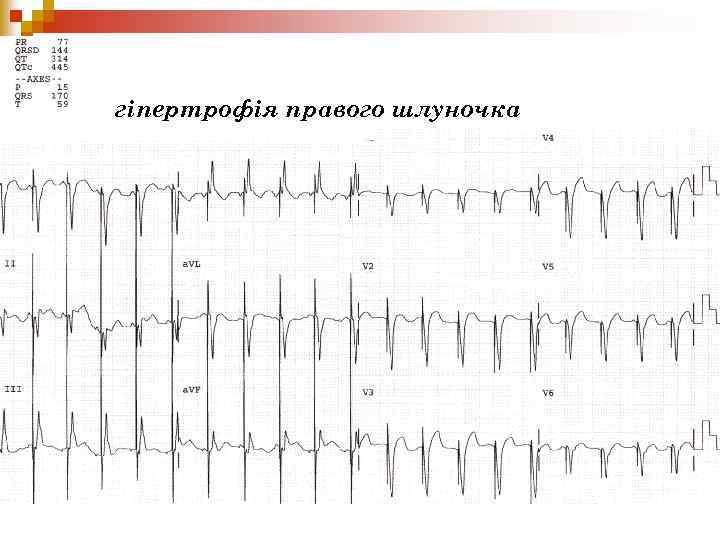 гіпертрофія правого шлуночка 