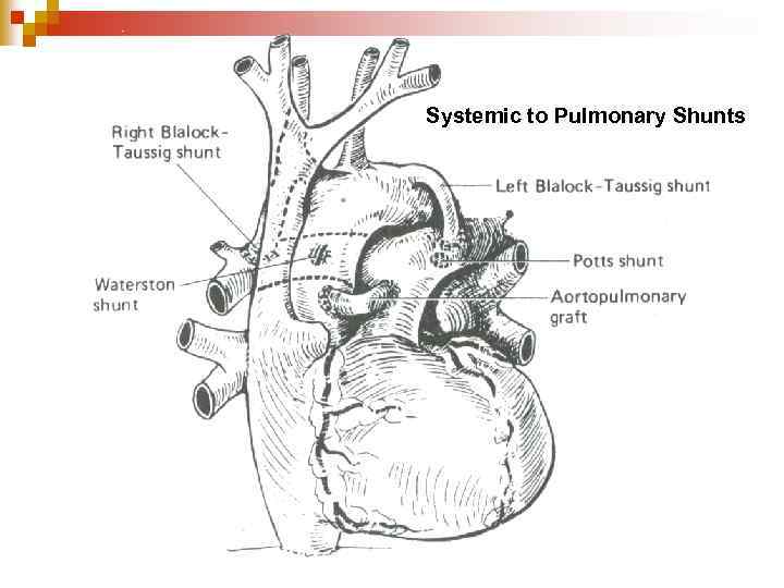 Systemic to Pulmonary Shunts 