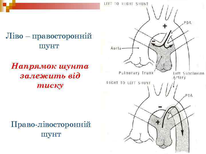 Ліво – правосторонній шунт Напрямок шунта залежить від тиску Право-лівосторонній шунт 