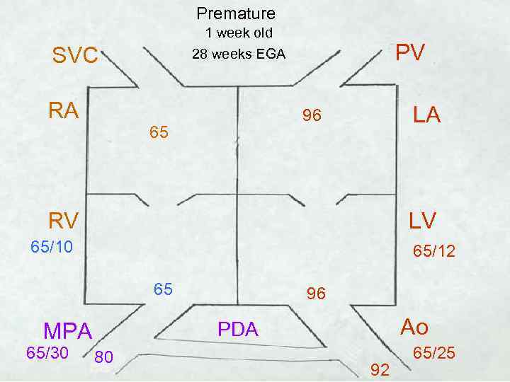 Premature 1 week old 28 weeks EGA SVC RA PV LA 96 65 RV