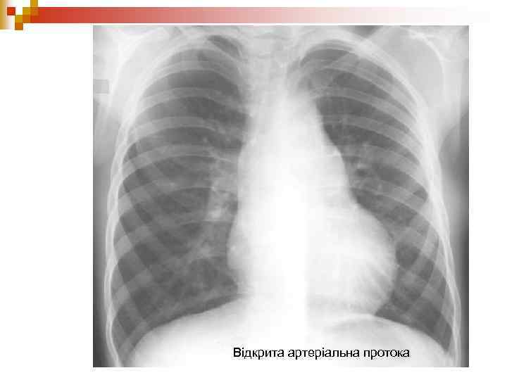 Відкрита артеріальна протока 