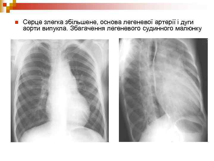 n Серце злегка збільшене, основа легеневої артерії і дуги аорти випукла. Збагачення легеневого судинного
