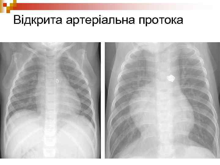 Відкрита артеріальна протока 