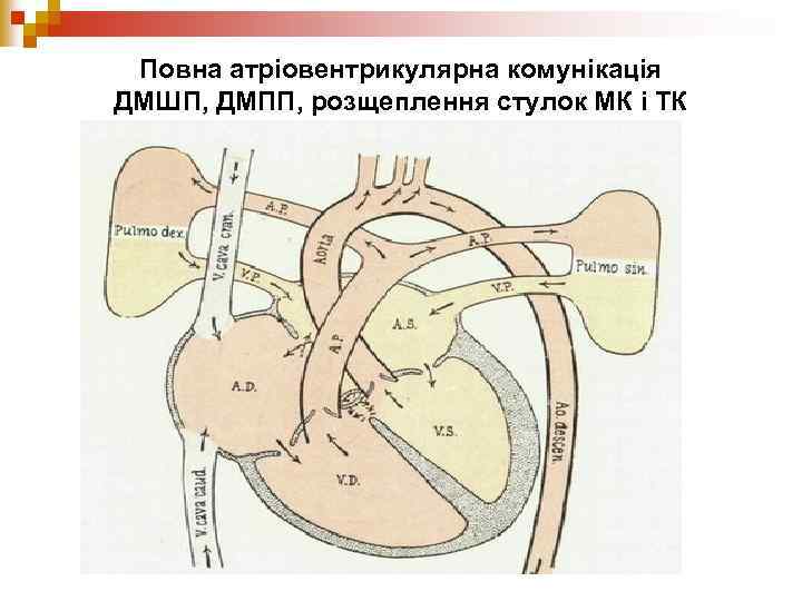 Повна атріовентрикулярна комунікація ДМШП, ДМПП, розщеплення стулок МК і ТК 
