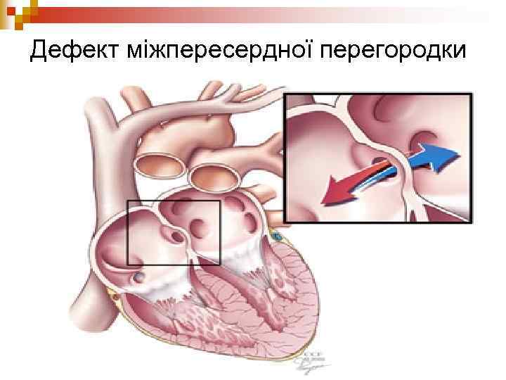 Дефект міжпересердної перегородки 