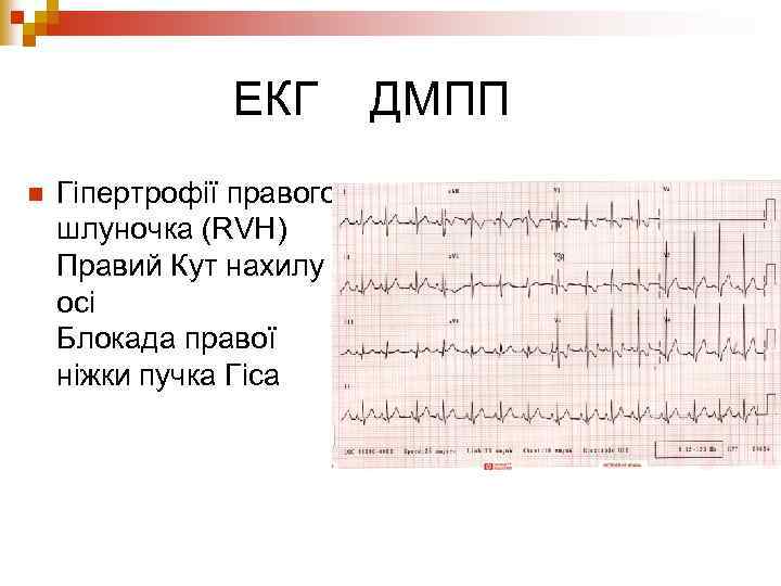 ЕКГ n Гіпертрофії правого шлуночка (RVH) Правий Кут нахилу осі Блокада правої ніжки пучка