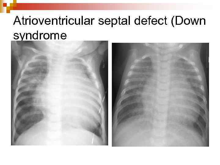 Atrioventricular septal defect (Down syndrome 