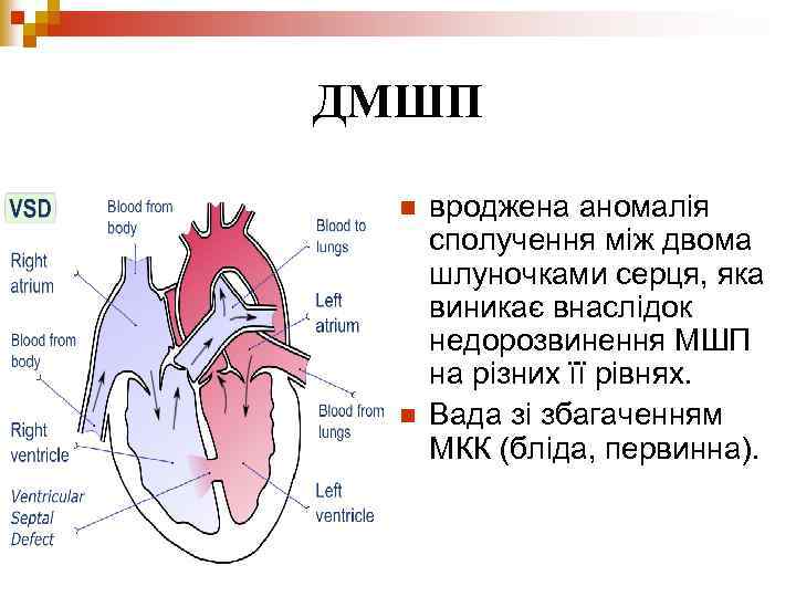 ДМШП n n вроджена аномалія сполучення між двома шлуночками серця, яка виникає внаслідок недорозвинення