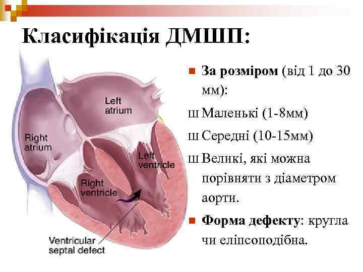 Класифікація ДМШП: n За розміром (від 1 до 30 мм): Ш Маленькі Ш Середні
