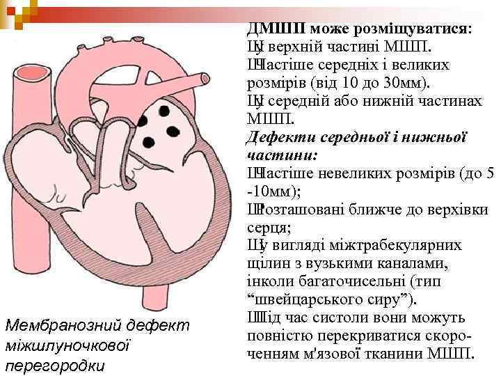 Мембранозний дефект міжшлуночкової перегородки ДМШП може розміщуватися: Ш верхній частині МШП. у Ш Частіше