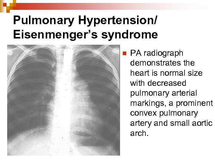 Pulmonary Hypertension/ Eisenmenger’s syndrome n PA radiograph demonstrates the heart is normal size with