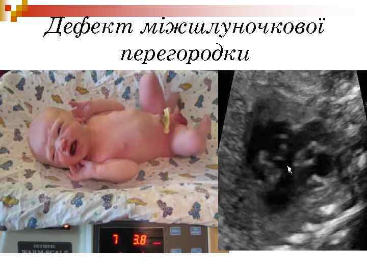 Дефект міжшлуночкової перегородки 