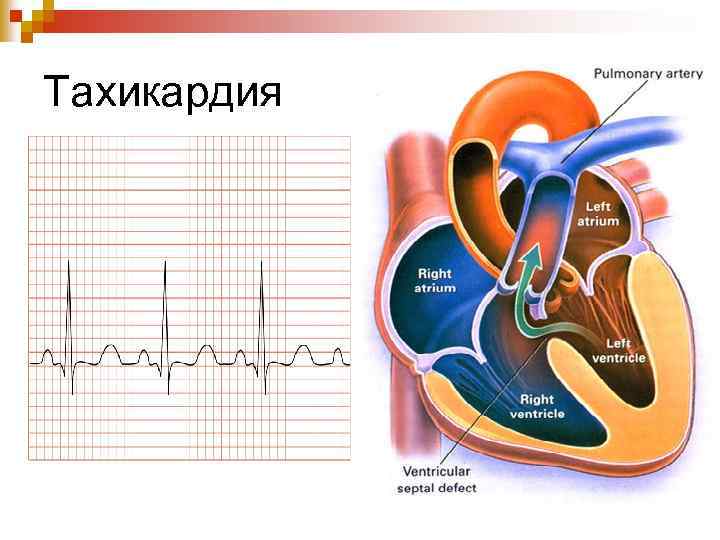 Тахикардия 