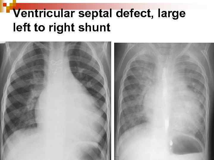 Ventricular septal defect, large left to right shunt 