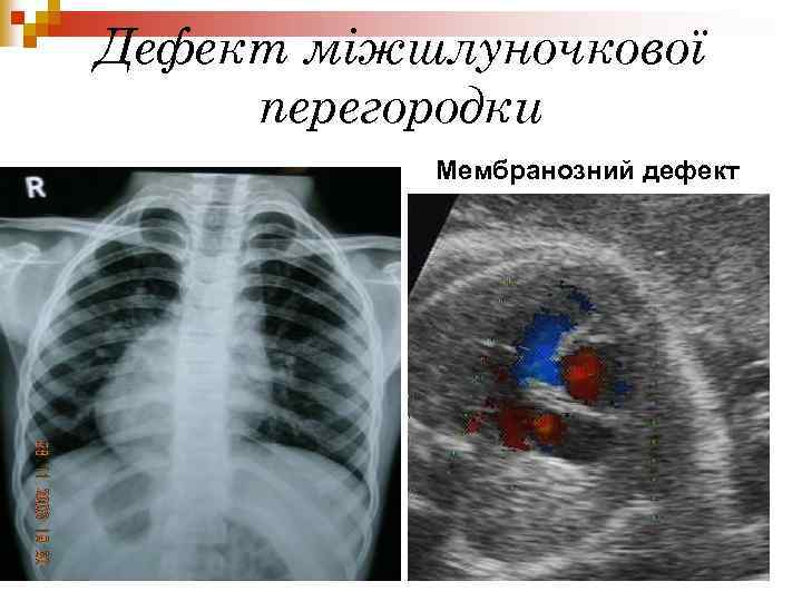 Дефект міжшлуночкової перегородки Мембранозний дефект 