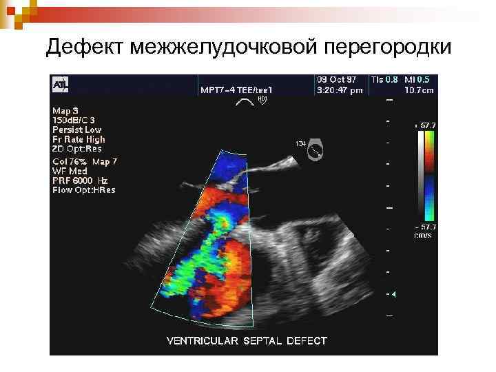 Дефект межжелудочковой перегородки 