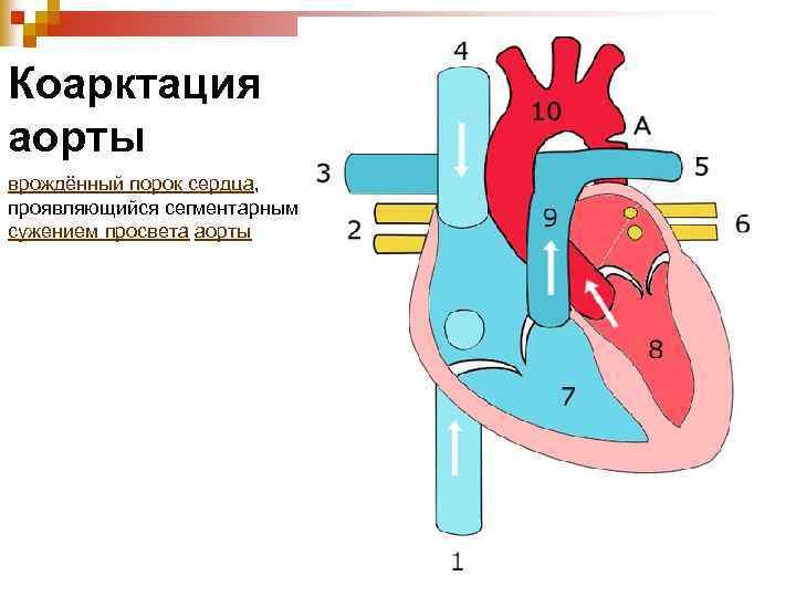 Коарктация аорты врождённый порок сердца, проявляющийся сегментарным сужением просвета аорты 