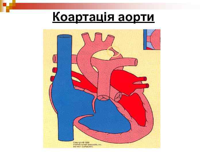 Коартація аорти 
