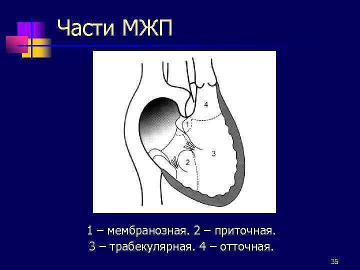 Части МЖП 1 – мембранозная. 2 – приточная. 3 – трабекулярная. 4 – отточная.