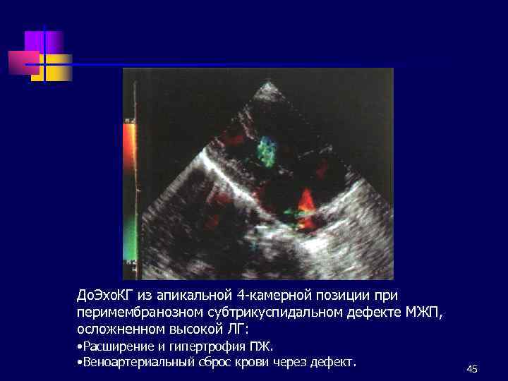 До. Эхо. КГ из апикальной 4 -камерной позиции при перимембранозном субтрикуспидальном дефекте МЖП, осложненном