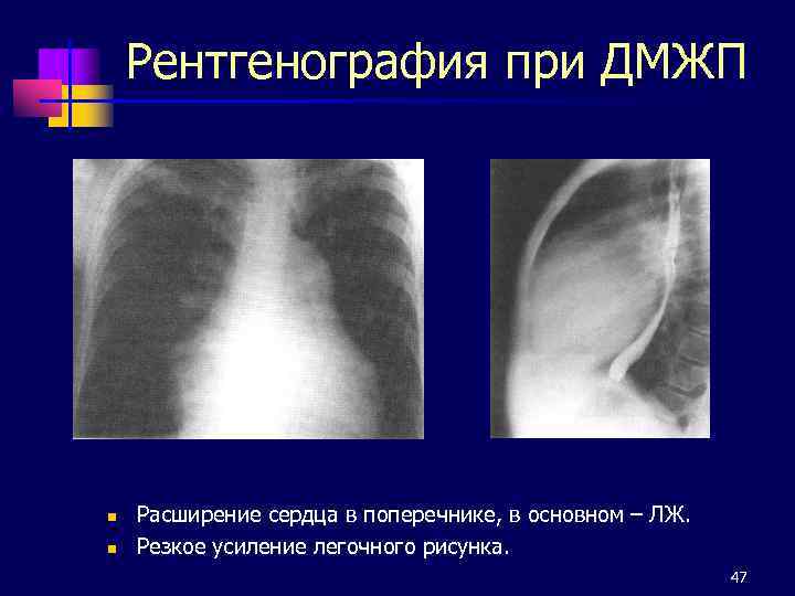 Рентгенография при ДМЖП n n Расширение сердца в поперечнике, в основном – ЛЖ. Резкое