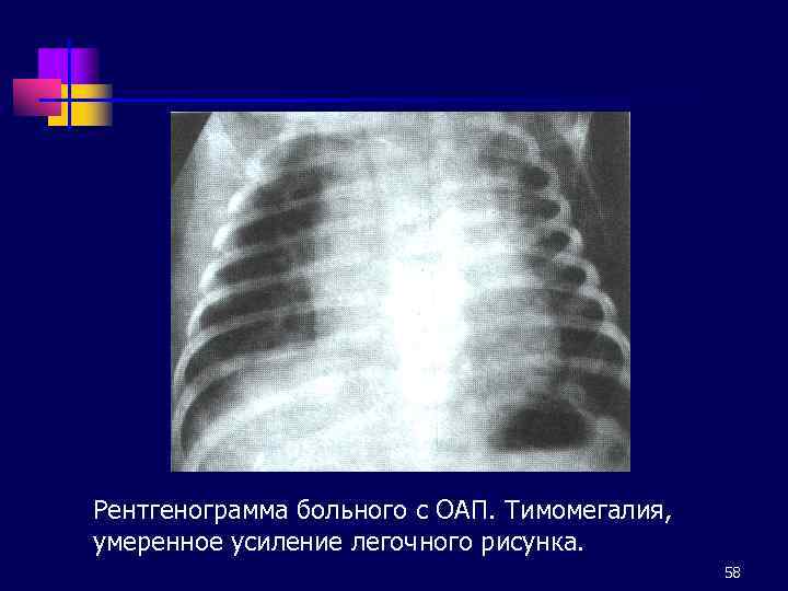 Рентгенограмма больного с ОАП. Тимомегалия, умеренное усиление легочного рисунка. 58 