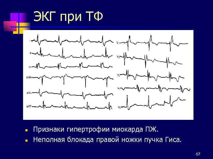 Экг нбпнпг что значит. Неполная блокада ПНПГ. Неполная блокада правой ножки. Неполная блокада правой ножки пучка. ЭКГ при врожденных пороках сердца.