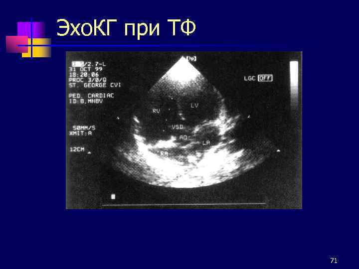 Эхо. КГ при ТФ 71 