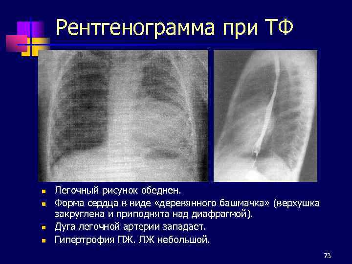 Рентгенограмма при ТФ n n Легочный рисунок обеднен. Форма сердца в виде «деревянного башмачка»