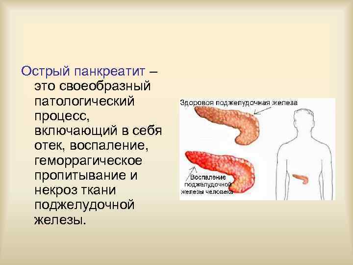 Острый панкреатит картинки