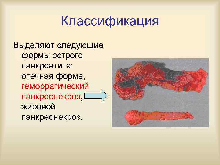 Стол 5 при панкреонекрозе