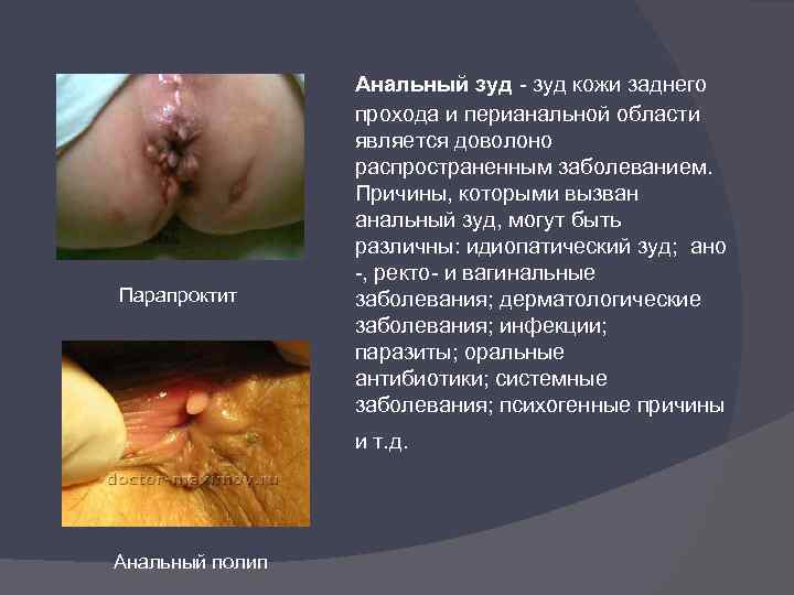 Парапроктит Анальный зуд - зуд кожи заднего прохода и перианальной области является доволоно распространенным
