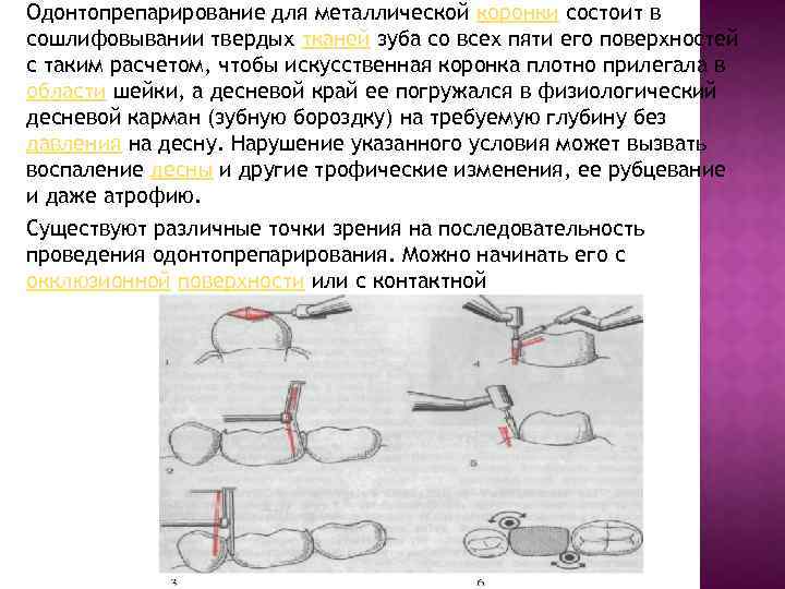 Одонтопрепарирование для металлической коронки состоит в сошлифовывании твердых тканей зуба со всех пяти его