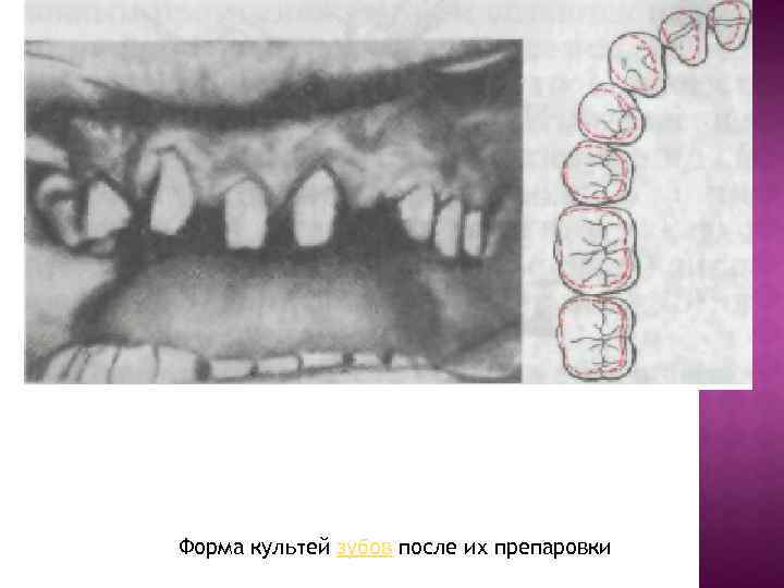 Форма культей зубов после их препаровки 