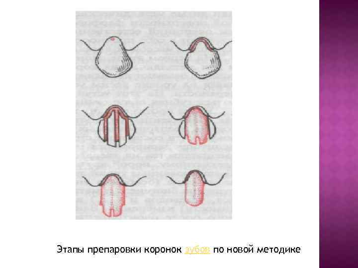 Этапы препаровки коронок зубов по новой методике 