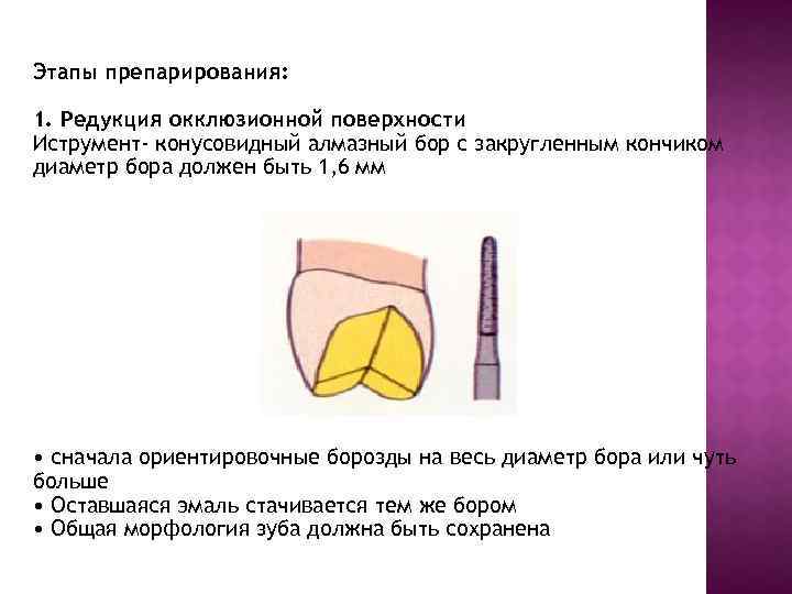 Этапы препарирования: 1. Редукция окклюзионной поверхности Иструмент- конусовидный алмазный бор с закругленным кончиком диаметр