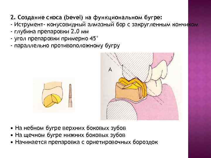 2. Создание скоса (bevel) на функциональном бугре: - Иструмент- конусовидный алмазный бор с закругленным