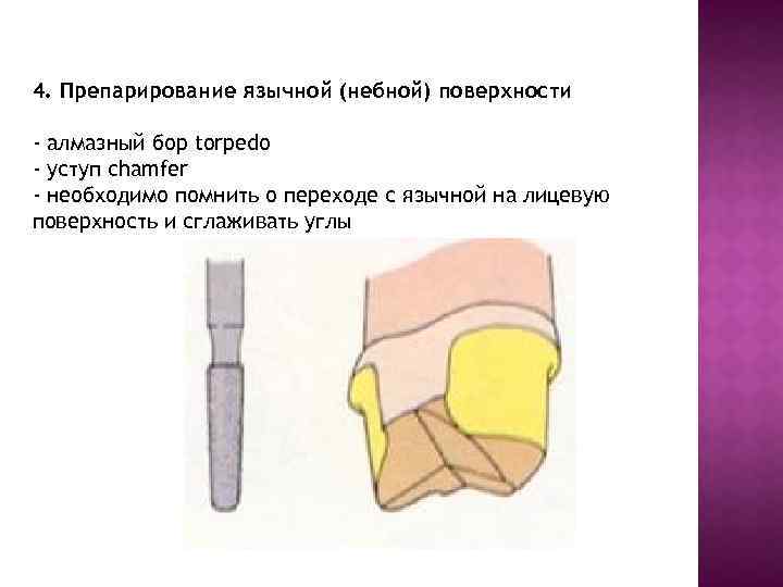 4. Препарирование язычной (небной) поверхности - алмазный бор torpedo - уступ chamfer - необходимо