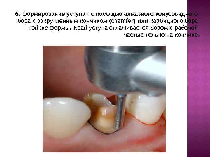 6. формирование уступа - с помощью алмазного конусовидного бора с закругленным кончиком (chamfer) или