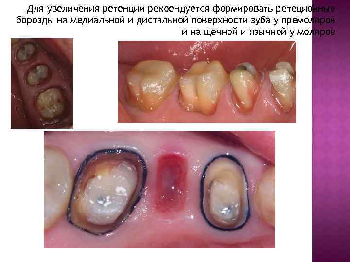 Для увеличения ретенции рекоендуется формировать ретеционные борозды на медиальной и дистальной поверхности зуба у