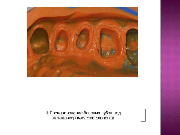 1. Препарирование боковых зубов под металлокерамические коронки 