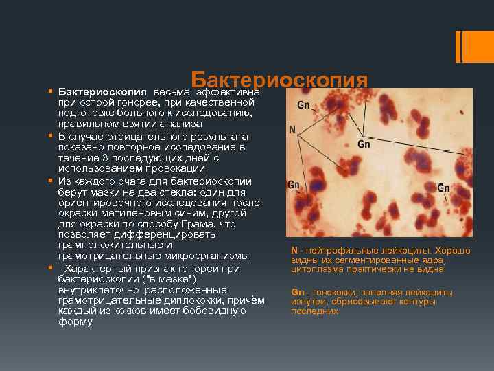 Бактериоскопия § Бактериоскопия весьма эффективна при острой гонорее, при качественной подготовке больного к исследованию,