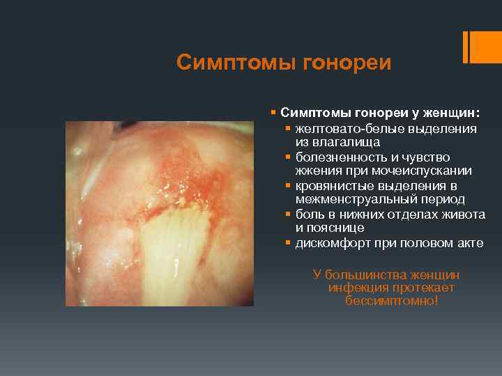Симптомы гонореи § Симптомы гонореи у женщин: § желтовато-белые выделения из влагалища § болезненность