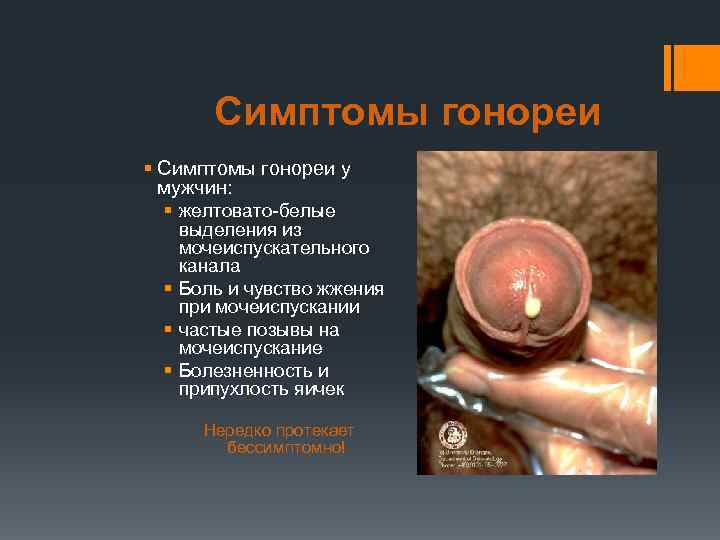 Симптомы гонореи § Симптомы гонореи у мужчин: § желтовато-белые выделения из мочеиспускательного канала §